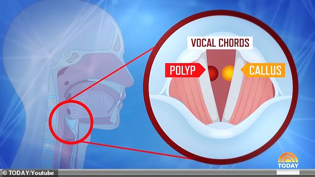 قام الدكتور بيك وو، أخصائي الصوت لدى جوثري، بإزالة ورم وعقيدات من كل جانب من الحبال الصوتية لمذيع التلفزيون.