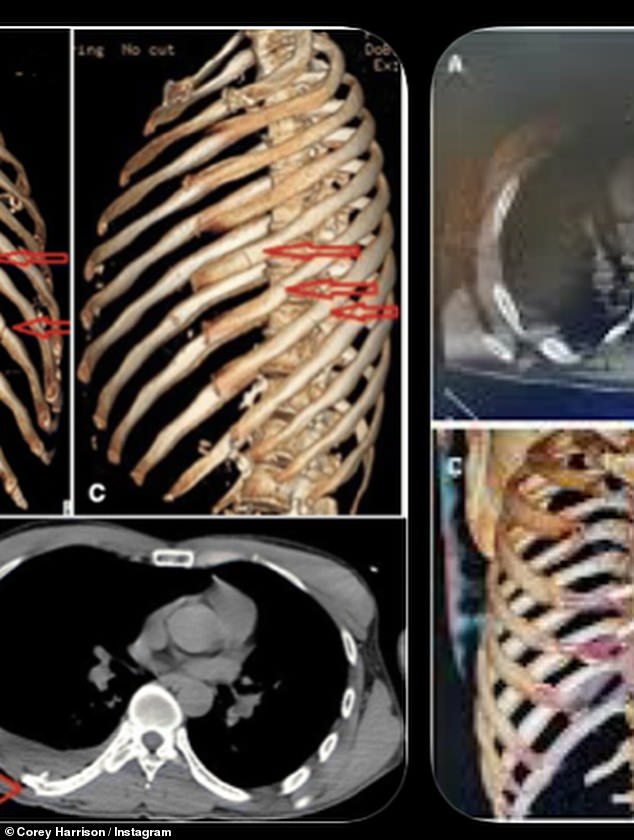 كما شارك رجل الأعمال صورة شخصية تظهر وجهه المقطوع أثناء تعافيه في المستشفى وفحص الأشعة السينية لعظامه المكسورة
