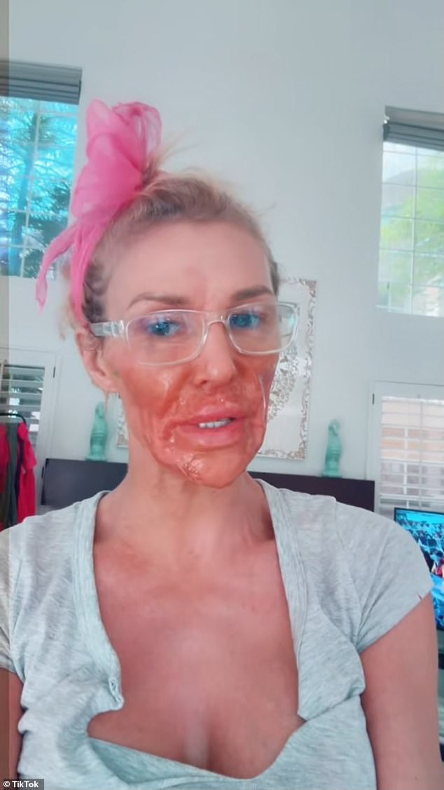 لقد أنفقت أكثر من 130 ألف دولار في محاولة لإصلاح المشكلة، وفي وقت ما حاولت علاج نفسها باستخدام كريم إزالة الشعر وحرق وجهها في هذه العملية؛ في الصورة في فيديو TikTok