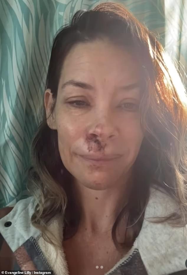 ويأتي هذا الكشف بعد ما يقرب من سبعة أشهر من مشاركتها صورًا مروعة لإصابات وجهها بعد سقوطها المروع على الشاطئ.